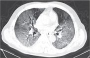 Photo of COVID-19 pneumonia: what has CT taught us?